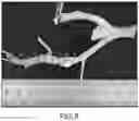 Fig. 09 - RADIOFREQUENCY BALLOON CATHETER SYSTEM