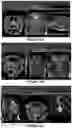 Fig. 11 - Mini-beam collimators for medical linear accelerators
