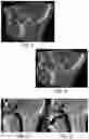 Fig. 03 - Low profile articulation jaw joint stabilizer device