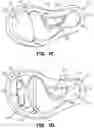 Fig. 04 - Adjustable foot support systems including fluid-filled bladder chambers
