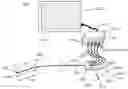 Fig. 01 - System and apparatus comprising a multi-sensor catheter for right heart and pulmonary artery catheterization