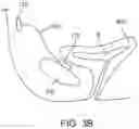 Fig. 06 - Apparatus, systems and methods for sensing bladder fullness