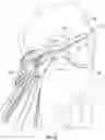Fig. 15 - Surgical fixation systems and methods