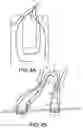 Fig. 05 - Surgical device for complex suturing fibrous tissues