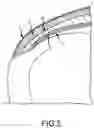 Fig. 06 - Surgical device for complex suturing fibrous tissues
