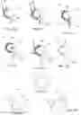 Fig. 14 - Surgical method and system for performing the same