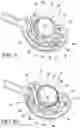 Fig. 06 - METHOD FOR SUTURE LACING