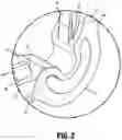 Fig. 03 - Ligation clip with improved hinge