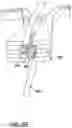 Fig. 11 - Surgical clip for simultaneous bleeding control of a blood vessel and cutting