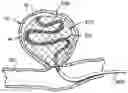 Fig. 01 - Delivery system for embolic braid