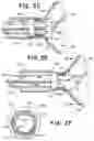 Fig. 04 - Delivery system for embolic braid
