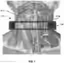 Fig. 02 - Methods and devices for reducing pressure