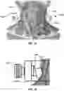 Fig. 08 - Methods and devices for reducing pressure