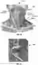 Fig. 24 - Methods and devices for reducing pressure