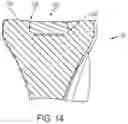 Fig. 15 - System for Articular Surface Replacement