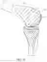 Fig. 16 - System for Articular Surface Replacement