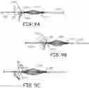 Fig. 10 - Embolectomy devices and methods for treatment of acute ischemic stroke condition