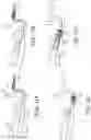 Fig. 12 - Embolectomy devices and methods for treatment of acute ischemic stroke condition