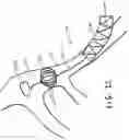 Fig. 23 - Thrombectomy systems and devices and methods of using the same