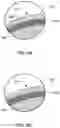 Fig. 04 - Ultrasonic surgical blades