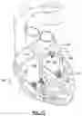 Fig. 13 - Systems and method or uses of ablating cardiac tissue