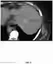 Fig. 13 - Systems and methods for ablation visualization