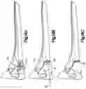 Fig. 12 - Surgical instrument handle with implant sizing feature and method of using