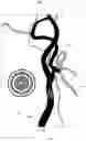 Fig. 10 - Blood vessel sizing device