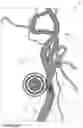 Fig. 15 - Blood vessel sizing device