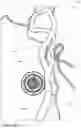 Fig. 16 - Blood vessel sizing device