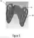 Fig. 05 - Arch adjustment appliance