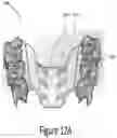 Fig. 15 - Arch adjustment appliance