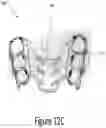 Fig. 17 - Arch adjustment appliance