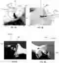 Fig. 03 - KIT AND METHOD FOR TRACKING A HUMAN JAW