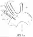 Fig. 04 - METHODS OF EMBOLIC DEFLECTION