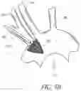 Fig. 05 - METHODS OF EMBOLIC DEFLECTION