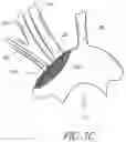Fig. 06 - METHODS OF EMBOLIC DEFLECTION