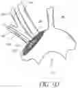 Fig. 07 - METHODS OF EMBOLIC DEFLECTION