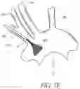 Fig. 08 - METHODS OF EMBOLIC DEFLECTION