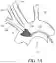 Fig. 09 - METHODS OF EMBOLIC DEFLECTION