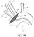 Fig. 10 - METHODS OF EMBOLIC DEFLECTION