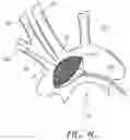 Fig. 11 - METHODS OF EMBOLIC DEFLECTION