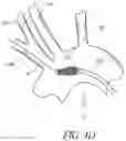 Fig. 12 - METHODS OF EMBOLIC DEFLECTION