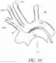 Fig. 13 - METHODS OF EMBOLIC DEFLECTION