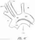 Fig. 14 - METHODS OF EMBOLIC DEFLECTION