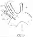 Fig. 25 - METHODS OF EMBOLIC DEFLECTION