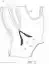 Fig. 26 - METHODS OF EMBOLIC DEFLECTION