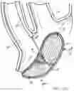 Fig. 27 - METHODS OF EMBOLIC DEFLECTION