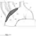Fig. 28 - METHODS OF EMBOLIC DEFLECTION