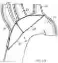 Fig. 29 - METHODS OF EMBOLIC DEFLECTION